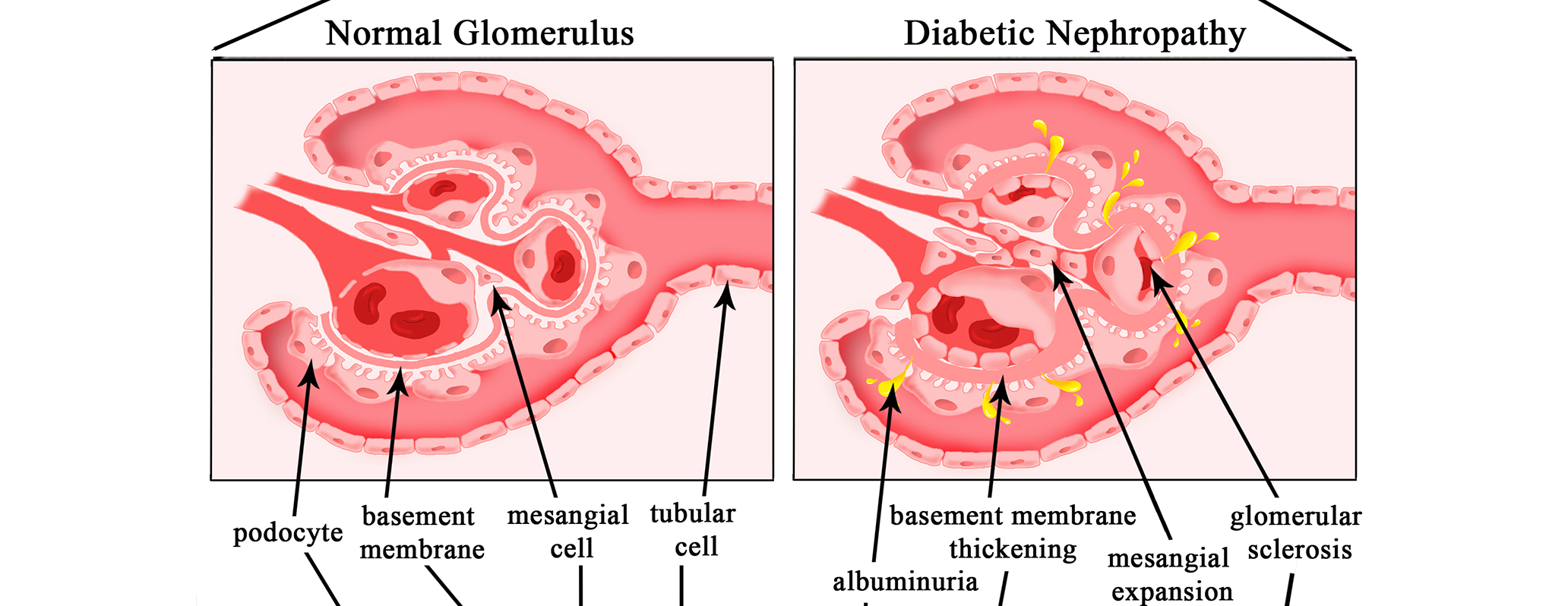 Illustrazione a mano libera di un glomerulo in condizioni fisiologiche (sx) e patologiche (dx)