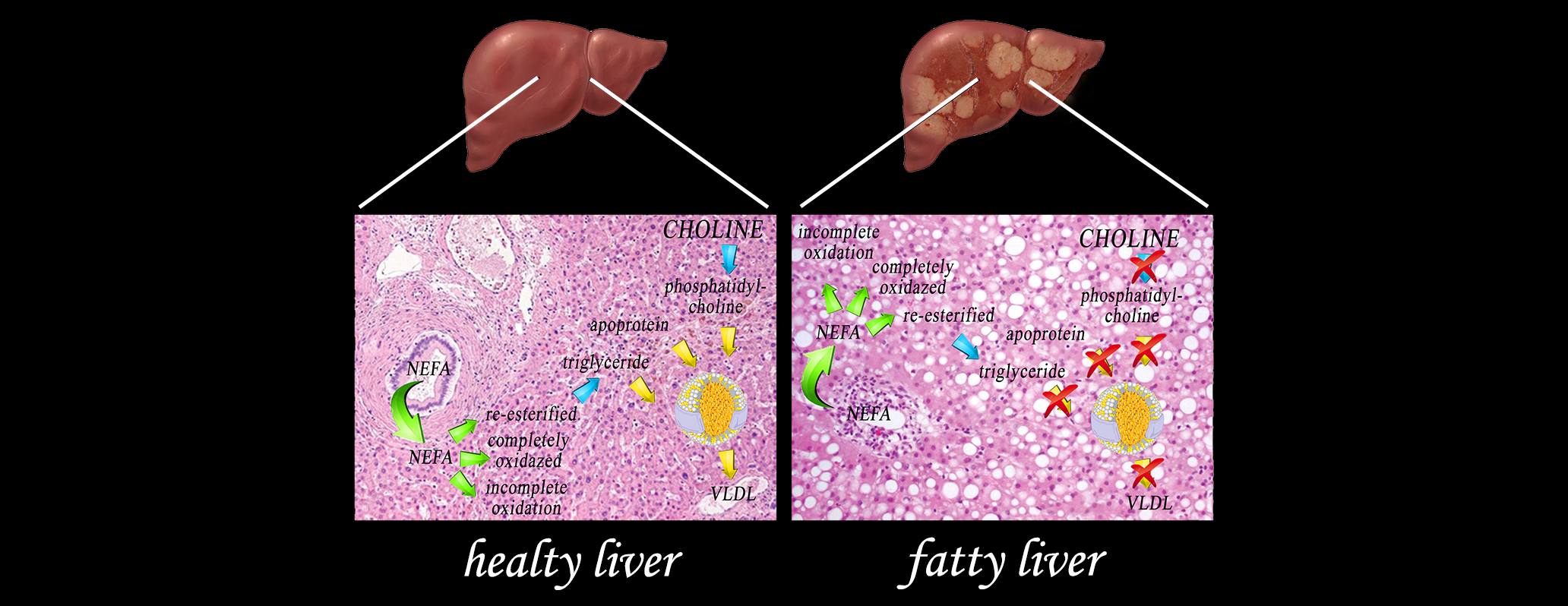 Illustrazione che descrive alcuni meccanismi molecolari epatici alterati, in condizioni di steatosi