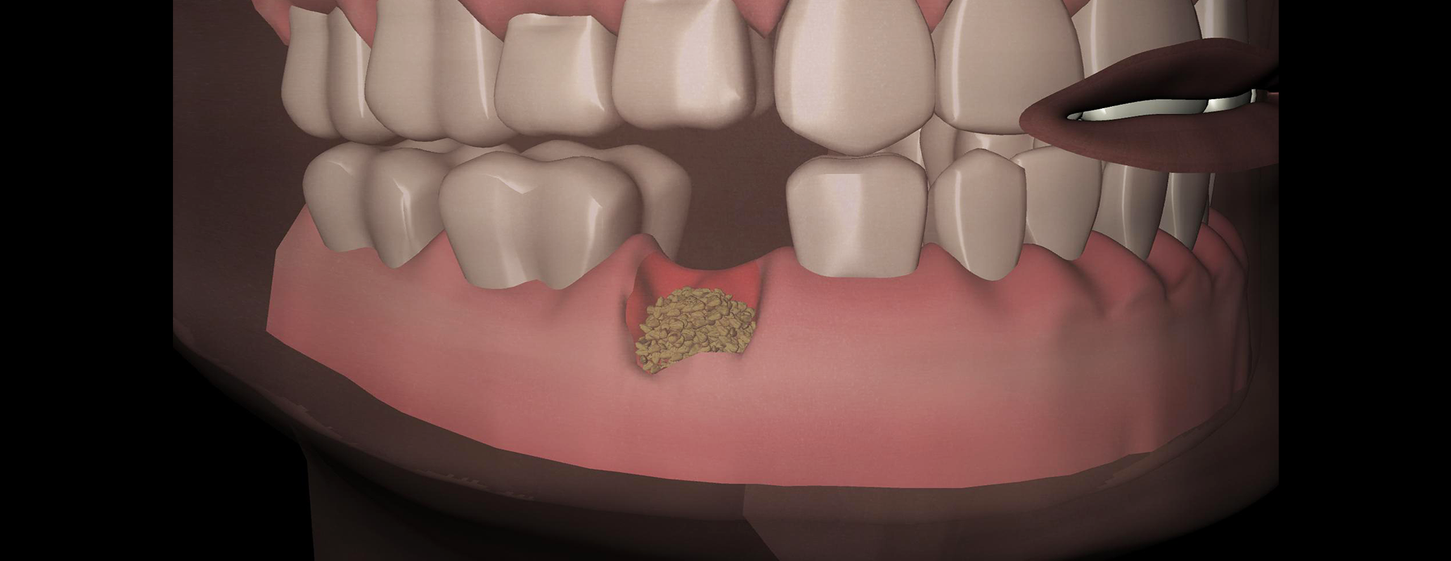 Ricostruzione 3D: granuli di ceramica bio-ricoperti e impiegati come riempitivo osseo. Panoramica