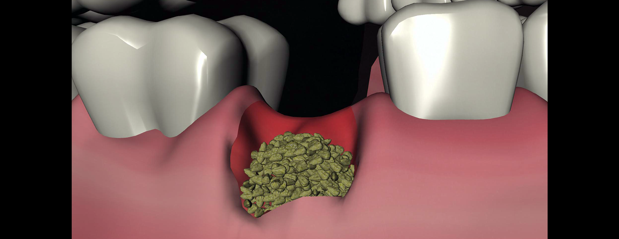 Ricostruzione 3D: granuli di ceramica bio-ricoperti e impiegati come riempitivo osseo. Particolare